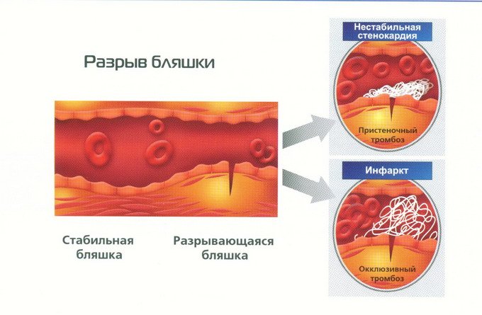 Тромб и бляшка разница. Разрыв атеросклеротической бляшки. Причины разрыва атеросклеротической бляшки. Отрыв атеросклеротической бляшки диагноз. Разрыв атеросклеротической бляшки патогенез.