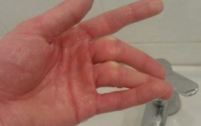 Перелом безіменного пальця: особливості, характерні симптоми і способи ефективного відновлення цілісності