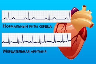 Валідол при тахікардії і серця і прискореному серцебитті