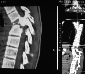 Компресійний осколковий перелом хребта: особливості травми, причини, методи діагностики та лікування