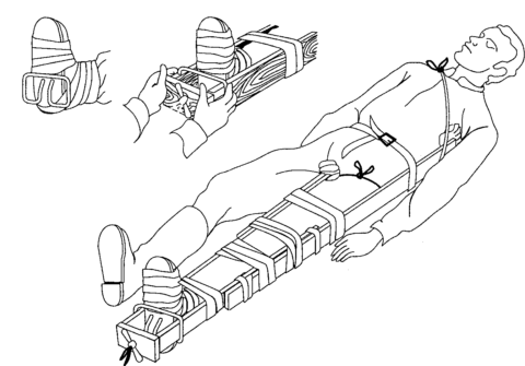 Транспортна шина для фіксації перелому стегна — види, способи накладення