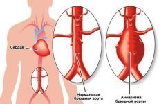 Аневризма черевної аорти: що це таке, симптоми і лікування