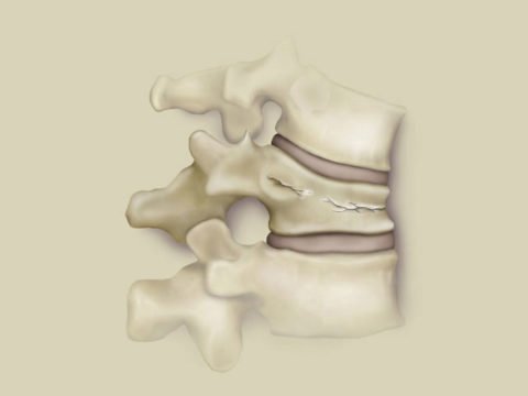 Як розпізнати патологічний компресійний перелом хребта, особливості травми, методи діагностики та лікування