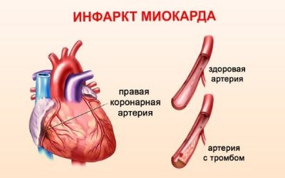 Трансмуральний інфаркт міокарда нижньої передньої стінки