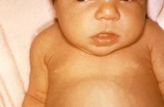 Урсофальк для новонароджених: інструкція, дозування, аналоги