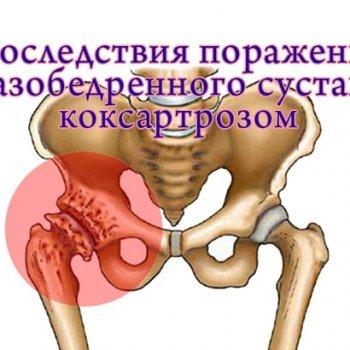 Патологічний перелом стегнової кістки: різновиди, причини, симптоматика та методи лікування