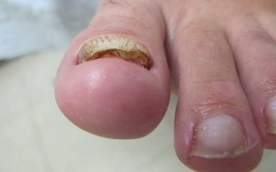 Видалення нігтя на нозі при грибку: пластиром, лазером та іншими засобами