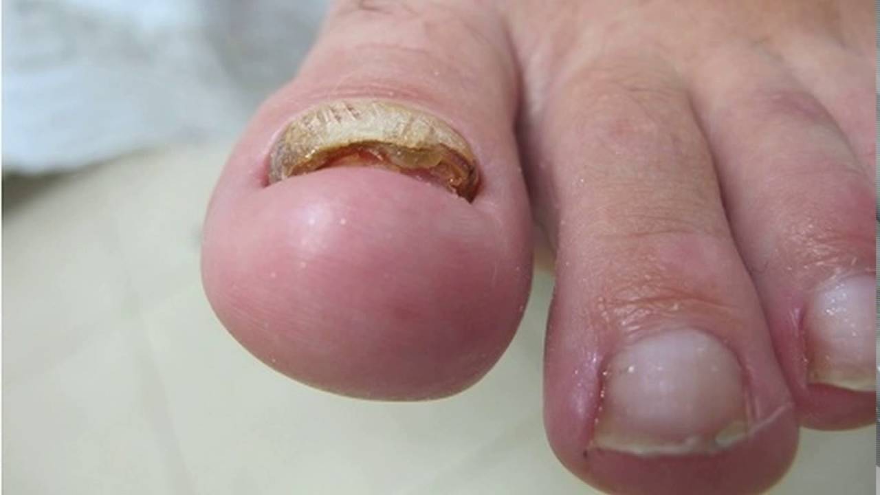Видалення нігтя на нозі при грибку: пластиром, лазером та іншими засобами