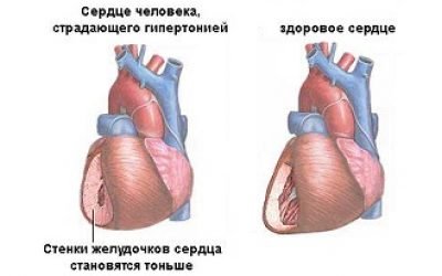 Високий серцевий тиск: як знизити ліками, що приймати, таблетки і препарати