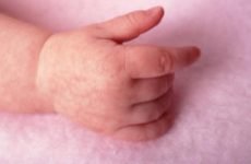 Переохолодження немовляти: симптоми гіпотермії новонароджених, профілактика та показання до штучного охолодження