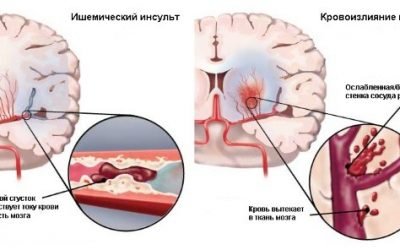 Чим відрізняється інсульт від інфаркту головного мозку: основні ознаки і відмінності