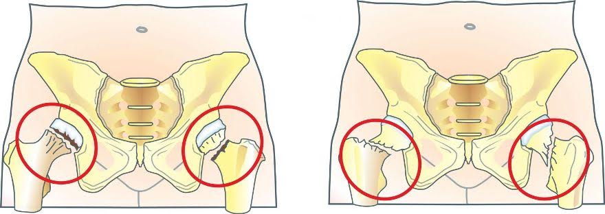 Характерні ознаки перелому шийки стегна