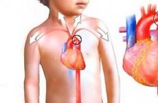 Коарктація аорти: види, діагностика та лікування вродженого пороку у дітей