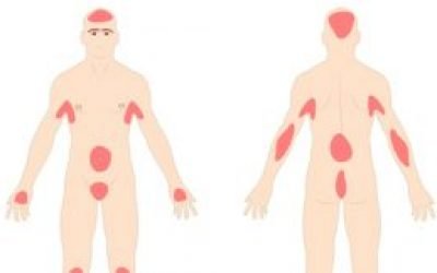 Псоріаз на тілі: як і чим лікувати. Засоби/препарати від псоріазу на шиї, спині, животі і грудях