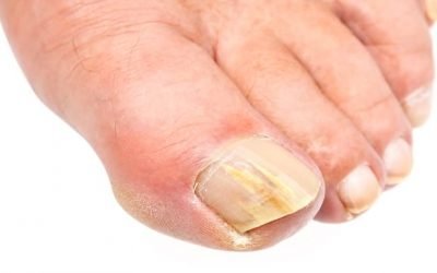 Лікування дріжджового грибка нігтів рук і ніг