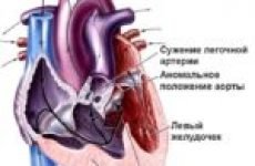 Характеристики та симптоми білих і синіх вад серця