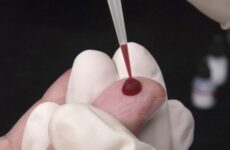 Чому буває підвищений гематокрит у крові
