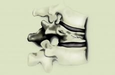 Як позначається компресійний перелом хребта – код за МКХ 10