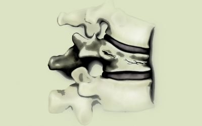 Як позначається компресійний перелом хребта – код за МКХ 10