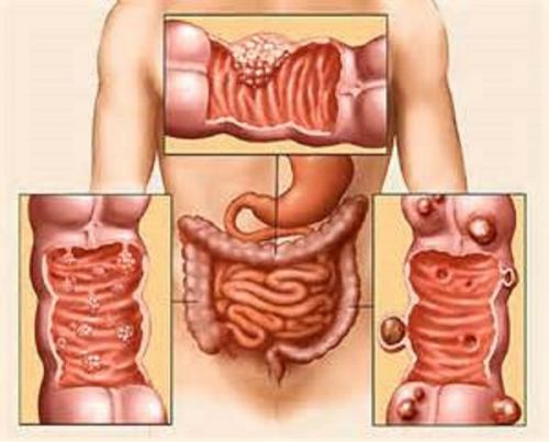 Захворювання товстої кишки: симптоми і лікування хвороб кишечника