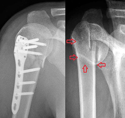 Лікування закритого перелому плеча в залежності від типу травми і області ушкодження
