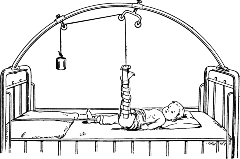 Перелом стегна у дитини: ознаки, причини, види, особливості лікування та можливі наслідки