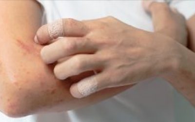 Алергічна екзема на руках: причини і лікування