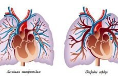 Симптоматика та методи лікування легеневої регургітації