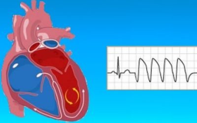 Шлуночкова аритмія серця – причини, симптоми і лікування