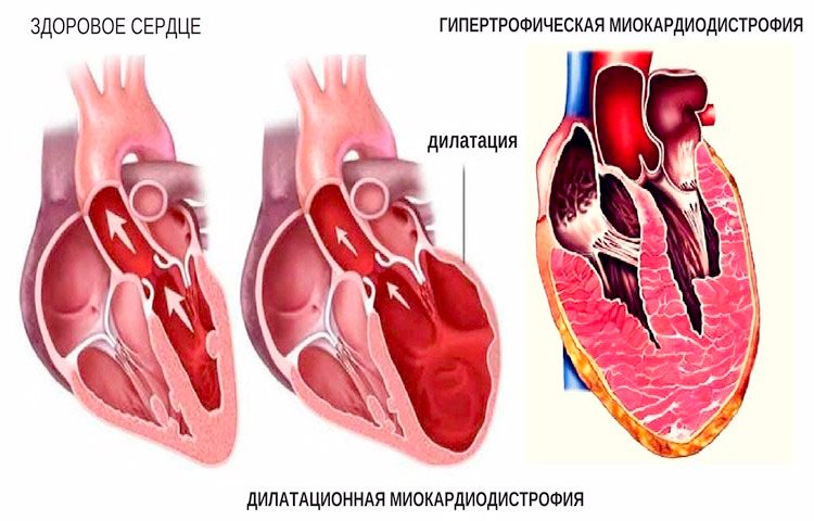 Изменения миокарда левого желудочка сердца. Миокардиодистрофия гистология. Кардиомиопатия и миокардиодистрофия. Гипертрофическая кардиомиопатия патанатомия. Миокардиодистрофия миокард.