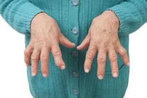 Лікування ревматоїдного артриту: препарати нового покоління, код за МКХ 10, перші симптоми