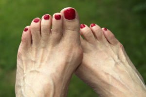 Чим лікувати подагру на нозі: що за хвороба, симптоми у чоловіків, лікування в домашніх умовах народними засобами, що приймати, пити?