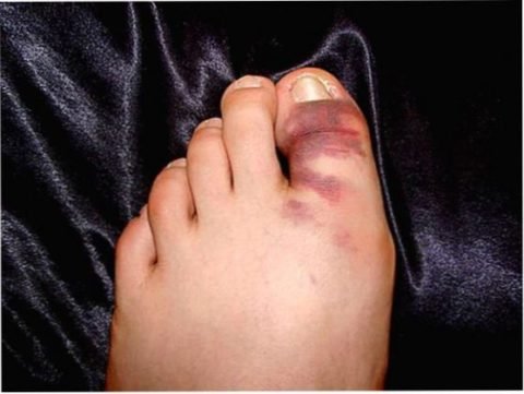 Перелом великого пальця ноги – причини, симптоми, лікування