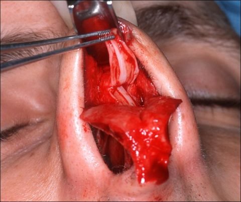 Перелом кісток носа: симптоми, методи лікування, поради лікарів