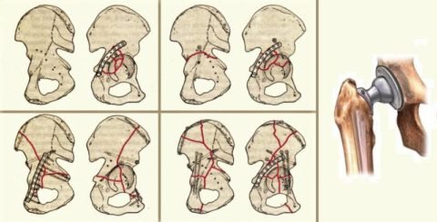 Перелом вертлюжної западини: види, лікування і наслідки травм тазових кісток