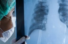 Вода і рідина в легенях: лікування, причини та наслідки при онкології, серцевої недостатності