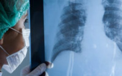 Вода і рідина в легенях: лікування, причини та наслідки при онкології, серцевої недостатності