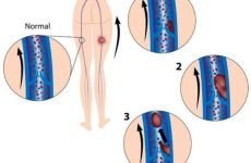 Флотуючий тромб: небезпека патології, причини і ознаки тромбозу, тактика лікування