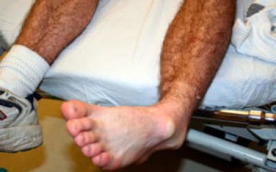 Вивих ноги в районі щиколотки (кісточки): симптоми і лікування, що робити з потерпілим