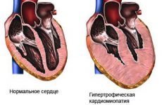 Чому буває велика (бичаче) серце: причини і лікування хвороби