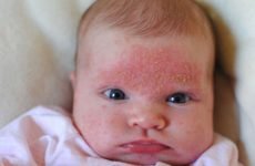 Атопічний дерматит у немовлят: лікування, симптоми та причини