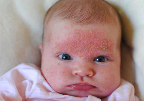 Атопічний дерматит у немовлят: лікування, симптоми та причини