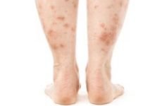 Псоріаз на ногах (ступнях, п’ятах): причини, симптоми, як і чим лікувати.