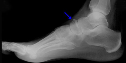 Різновиди переломів стопи – симптоматичні ознаки, причини отриманих травм, способи лікування і особливості реабілітаційного періоду