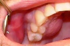 Запалення окістя зуба: причини, симптоми і методи лікування