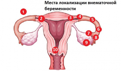 Позаматкова вагітність по тижнях: до якого строку може розвиватися, ознаки і симптоми патологічного стану на 4, 5, 6, 7 і 10 11 тижнях