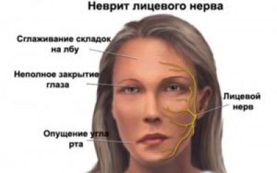 Гімнастика для обличчя при невриті лицьового нерва
