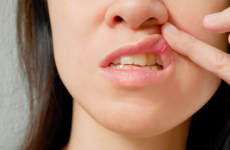 Запалення слизової оболонки порожнини рота: причини і методи лікування
