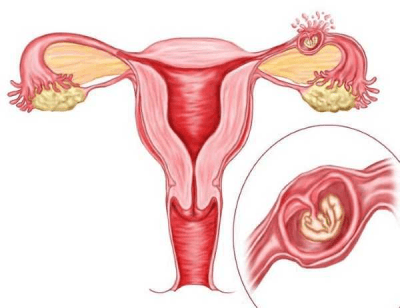 Виділення при позаматкової вагітності: які бувають на ранніх термінах і може бути позаматкова вагітність без кровянистих виділень