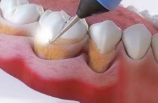 Зубний наліт: причини виникнення, методи відбілювання та профілактики
